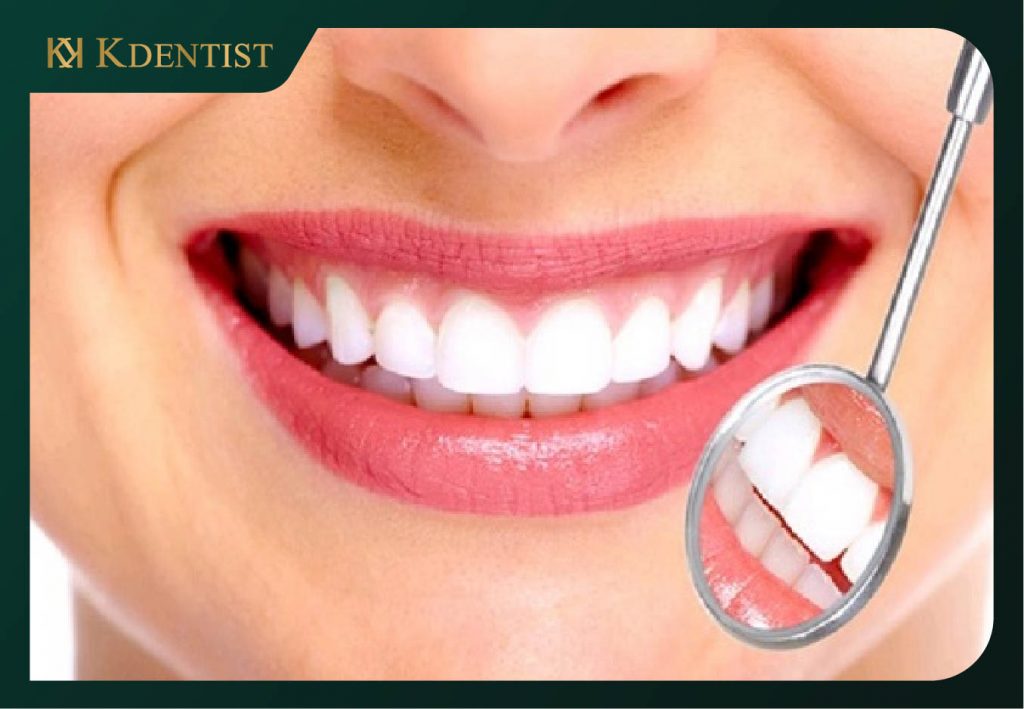 Hình ảnh bệnh nhân cắt lợi tại nha khoa Kdentist