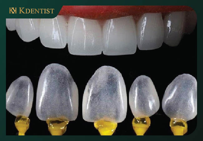 Loại dán răng sứ phổ biến