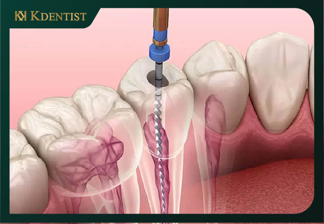 Khái niệm về chữa tủy răng Khái niệm về chữa tủy răng