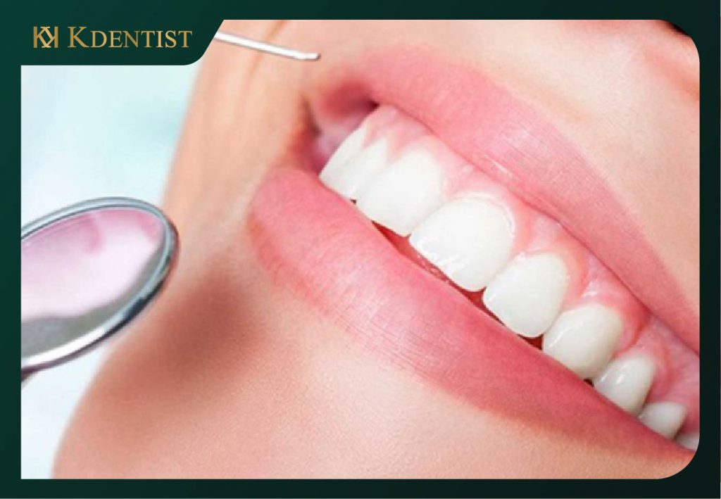 Cắt nướu răng bao nhiêu tiền Cắt nướu răng bao nhiêu tiền