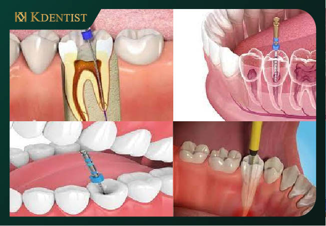 Các trường hợp cần chữa tủy răng Các trường hợp cần chữa tủy răng