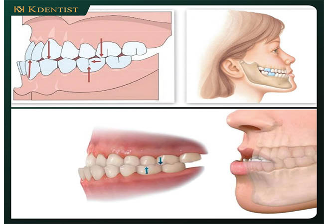 Dịch vụ niềng răng tại Quy Nhơn Dịch vụ niềng răng tại Quy Nhơn