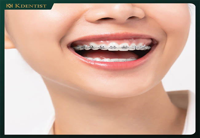 niềng răng thẩm mỹ niềng răng thẩm mỹ