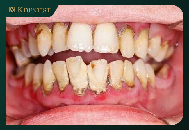 Các nguyên nhân bị cao răng Các nguyên nhân bị cao răng