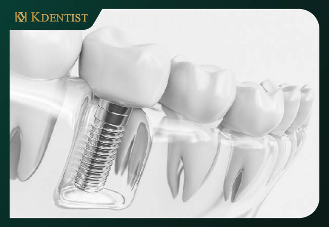Số lượng răng cần cắm implant Số lượng răng cần cắm implant