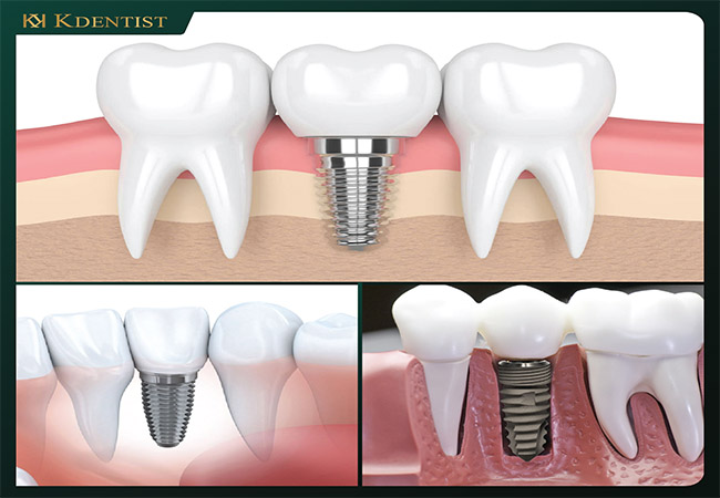 Cam kết của KDENTIST tới khách hàng Trồng răng implant