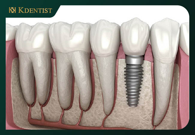 Trồng răng implant giá bao nhiêu Trồng răng implant giá bao nhiêu
