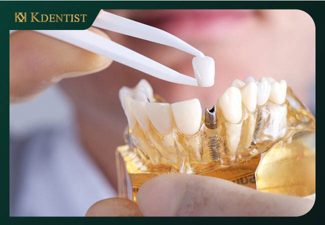 Dịch vụ trồng răng implant ở Quy Nhơn Dịch vụ trồng răng implant ở Quy Nhơn