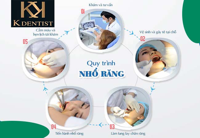 Quy trình nhổ răng