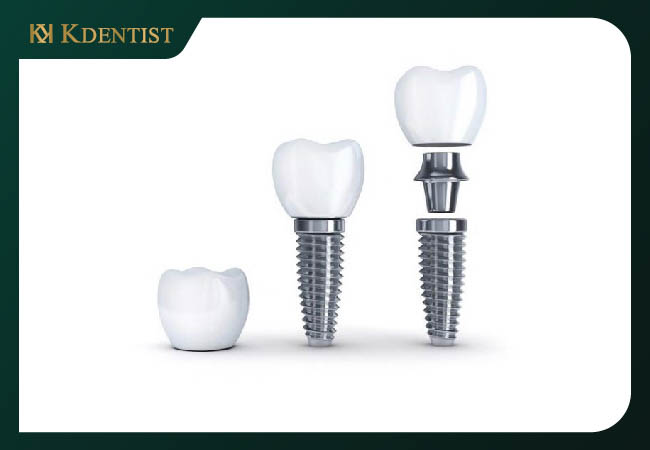 Nguồn góc xuất sứ của răng implant hàn quốc Nguồn góc xuất sứ của răng implant hàn quốc