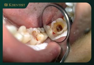 Bị chết tủy răng Bị chết tủy răng