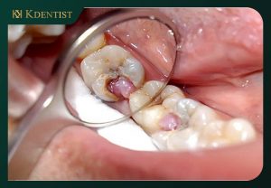 Bị viêm tủy răng Bị viêm tủy răng