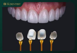 Chất lượng răng sứ cao cấp Chất lượng răng sứ cao cấp