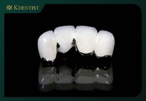 Bọc răng sứ titan Bọc răng sứ titan