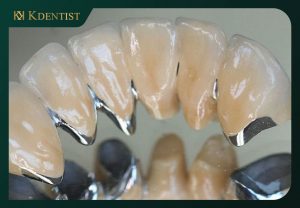 Bọc răng sứ kim loại thường Bọc răng sứ kim loại thường