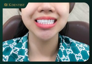 Tình trạng khuyết tật của răng Tình trạng khuyết tật của răng