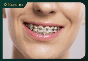 Niềng răng thẩm mỹ Niềng răng thẩm mỹ