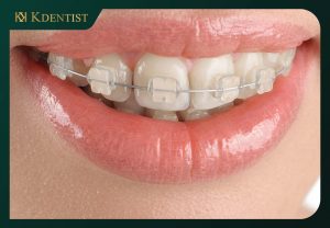 Niềng răng mắc cài sứ Niềng răng mắc cài sứ