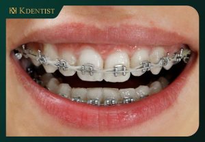 Niềng răng mắc cài kim loại Niềng răng mắc cài kim loại