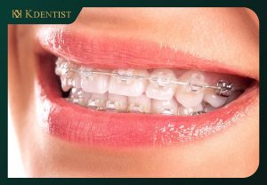 Giá niềng răng mắc cài sứ Giá niềng răng mắc cài sứ