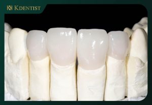 Chất liệu làm nên răng sứ Chất liệu làm nên răng sứ