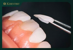 Có nên lựa chọn bọc răng sứ với chi phí rẻ Có nên lựa chọn bọc răng sứ với chi phí rẻ
