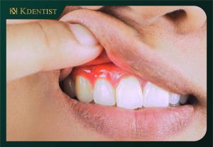 Cải thiện tính thẩm mỹ của răng Cải thiện tính thẩm mỹ của răng