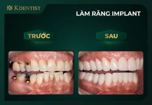 Có nên trồng răng implant không?