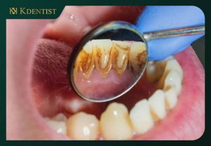 Dịch vụ cạo vôi răng Quảng Ngãi của KDENTIST Dịch vụ cạo vôi răng Quảng Ngãi của KDENTIST