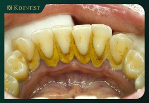 Dịch vụ cạo vôi răng tại QUy Nhơn Dịch vụ cạo vôi răng tại QUy Nhơn