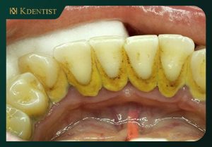 Tình trạng răng cần cạo vôi răng Tình trạng răng cần cạo vôi răng
