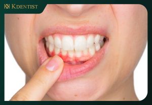 Phương pháp điều trị viêm nha chu Phương pháp điều trị viêm nha chu