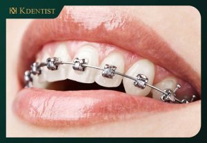 Phương pháp niềng răng Phương pháp niềng răng
