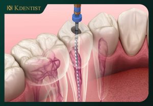 Các yếu tố ảnh hưởng tới chi phí chữa tủy răng Các yếu tố ảnh hưởng tới chi phí chữa tủy răng