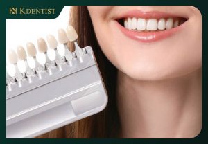 Số lượng răng cần dán sứ veneer Số lượng răng cần dán sứ veneer