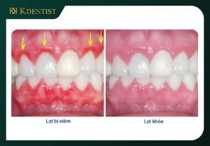 Nướu (lợi) phải tốt Nướu (lợi) phải tốt