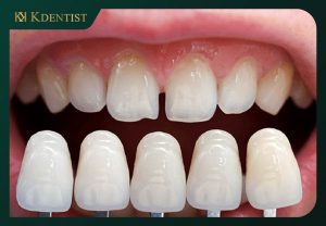 Nguồn gốc, công nghệ sản xuất răng sứ Nguồn gốc, công nghệ sản xuất răng sứ