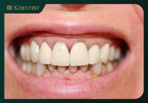 Những điều kiện bắt buộc để được dán răng sứ veneer Những điều kiện bắt buộc để được dán răng sứ veneer