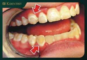 Tình trạng bị viêm nha chu Tình trạng bị viêm nha chu