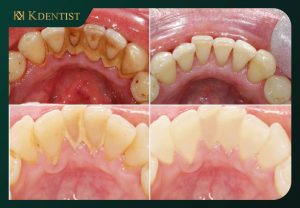 Các trường hợp nên cạo vôi răng Các trường hợp nên cạo vôi răng