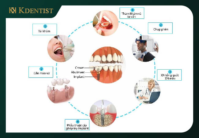 Quy trình trồng răng implant Hàn Quốc Quy trình trồng răng implant Hàn Quốc