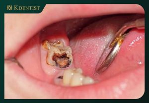 Tình trạng của tủy răng Tình trạng của tủy răng