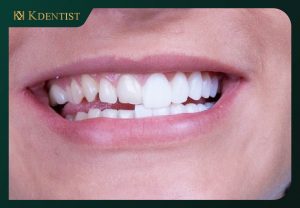 Răng chắc khỏe, không hư hại Răng chắc khỏe, không hư hại