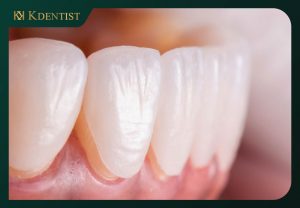 Dán răng sứ veneer Dán răng sứ veneer