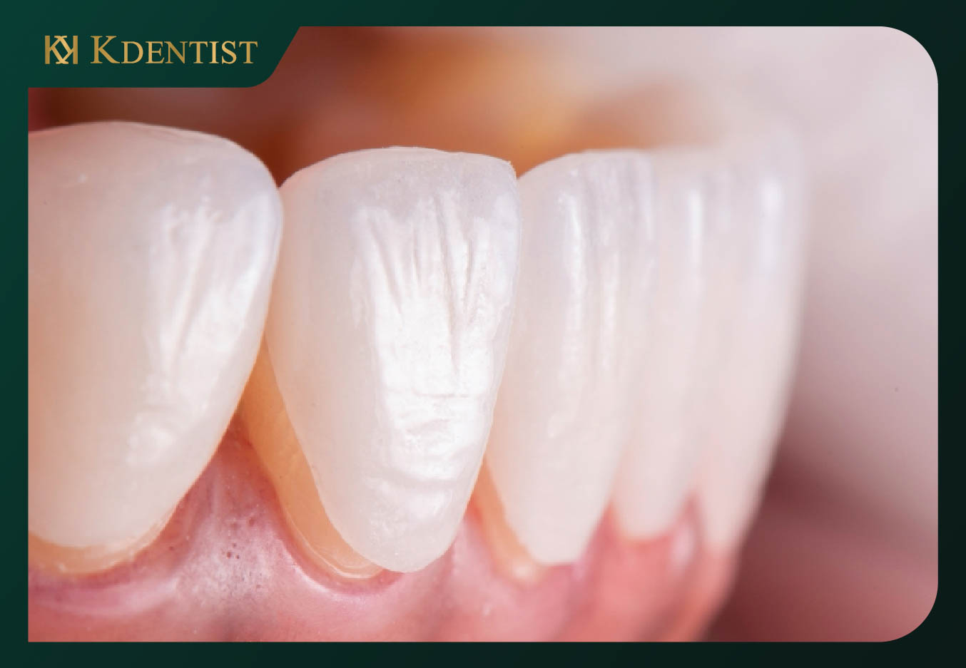 Dán răng sứ veneer