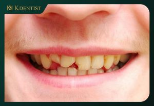 Răng bị sứt mẻ