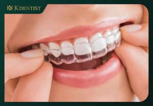 Niềng răng không mắc cài invisalign Niềng răng không mắc cài invisalign