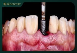 Cấy ghép implant. Cấy ghép sai lệch vị trí cần cắm implant