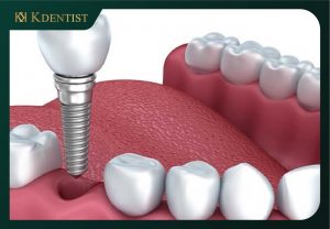 nhổ răng bao lâu thì cắm implant