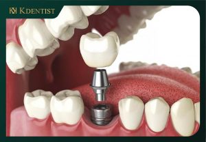Tuổi thọ của trồng răng implant cao Tuổi thọ của trồng răng implant cao